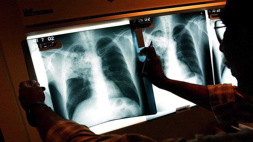 2 active tuberculosis cases traced to San Francisco strip club — KTVU FOX 2 Bay Area, Belvedere Health news